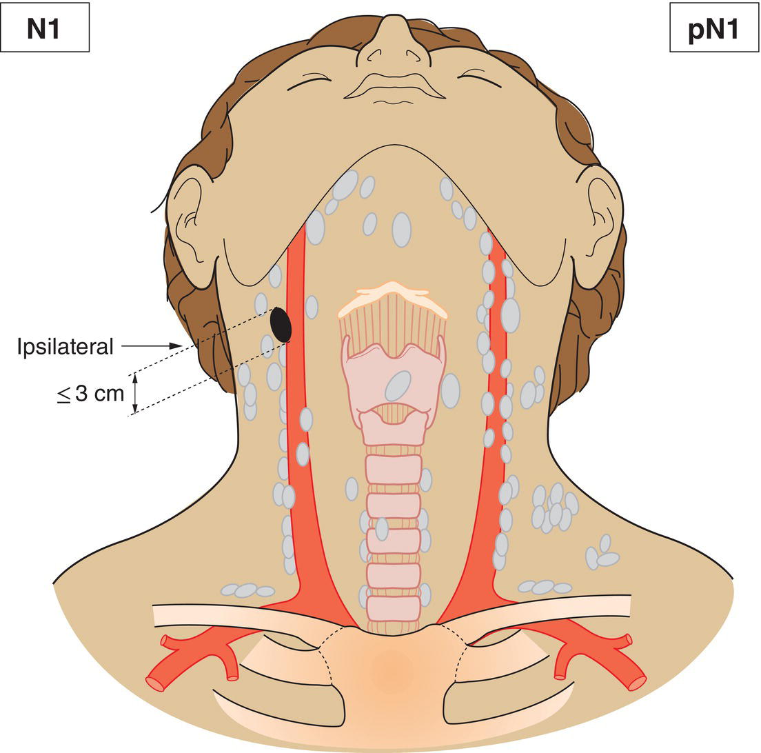 Schematic illustration of Metastasis in a single ipsilateral lymph node, 3 cm or less in greatest dimension without extranodal extension.