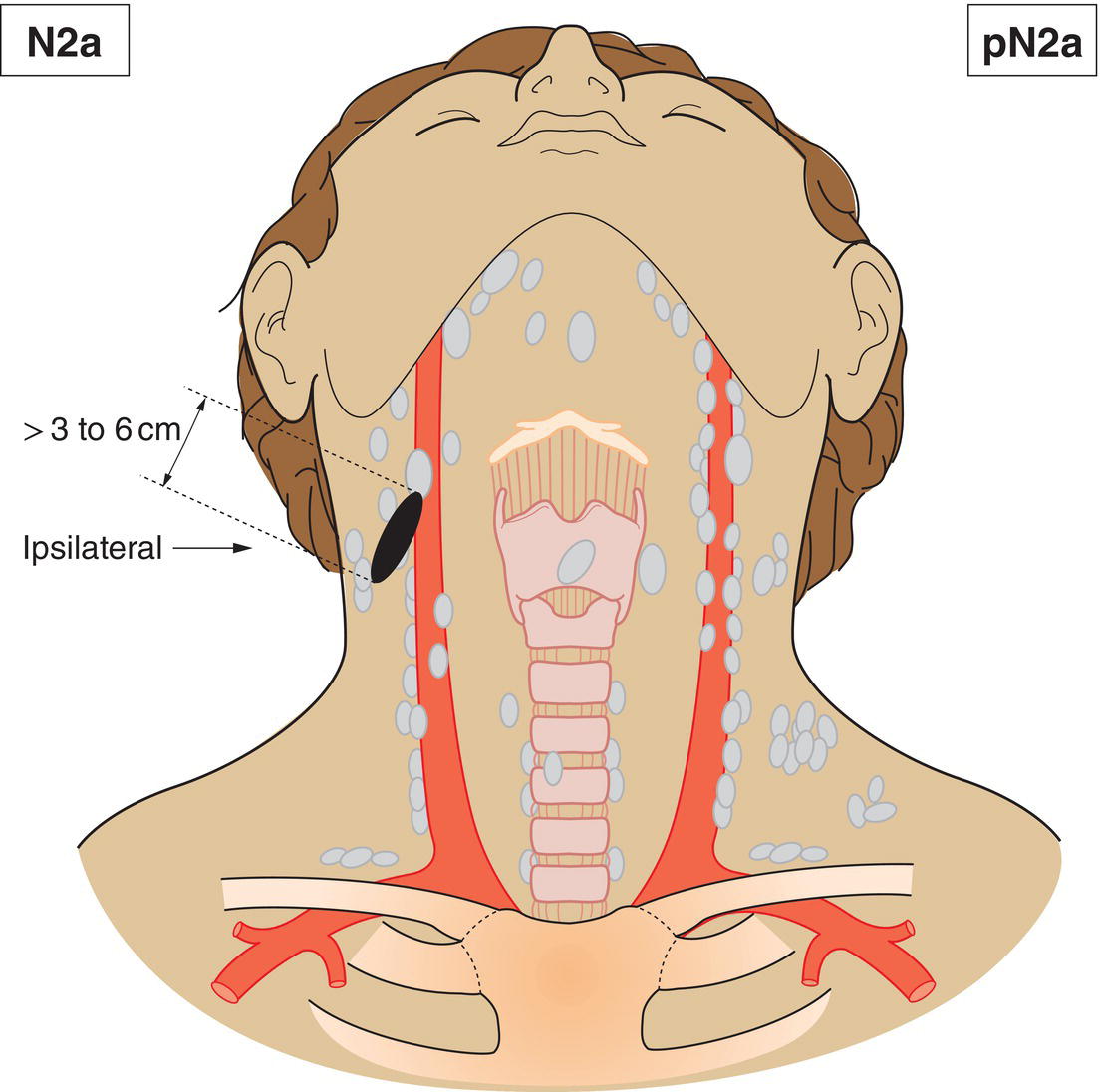 Schematic illustration of Metastasis in a single ipsilateral lymph node more than 3 cm but not more than 6 cm in greatest dimension without extranodal extension.