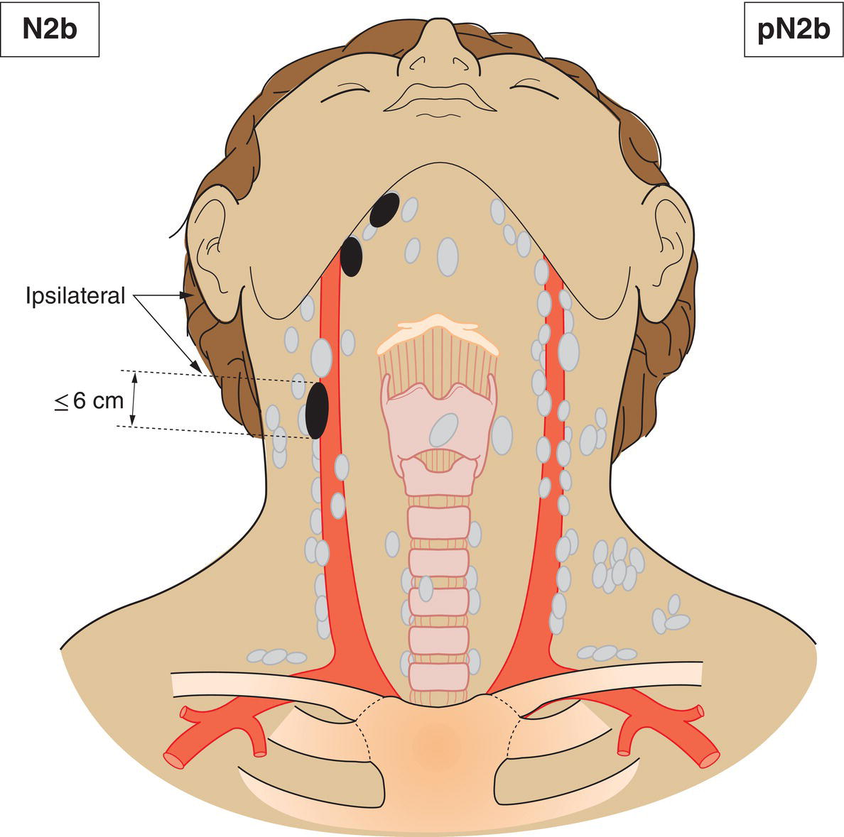 Schematic illustration of Metastasis in multiple ipsilateral lymph nodes, none more than 6 cm in greatest dimension, without extranodal extension.