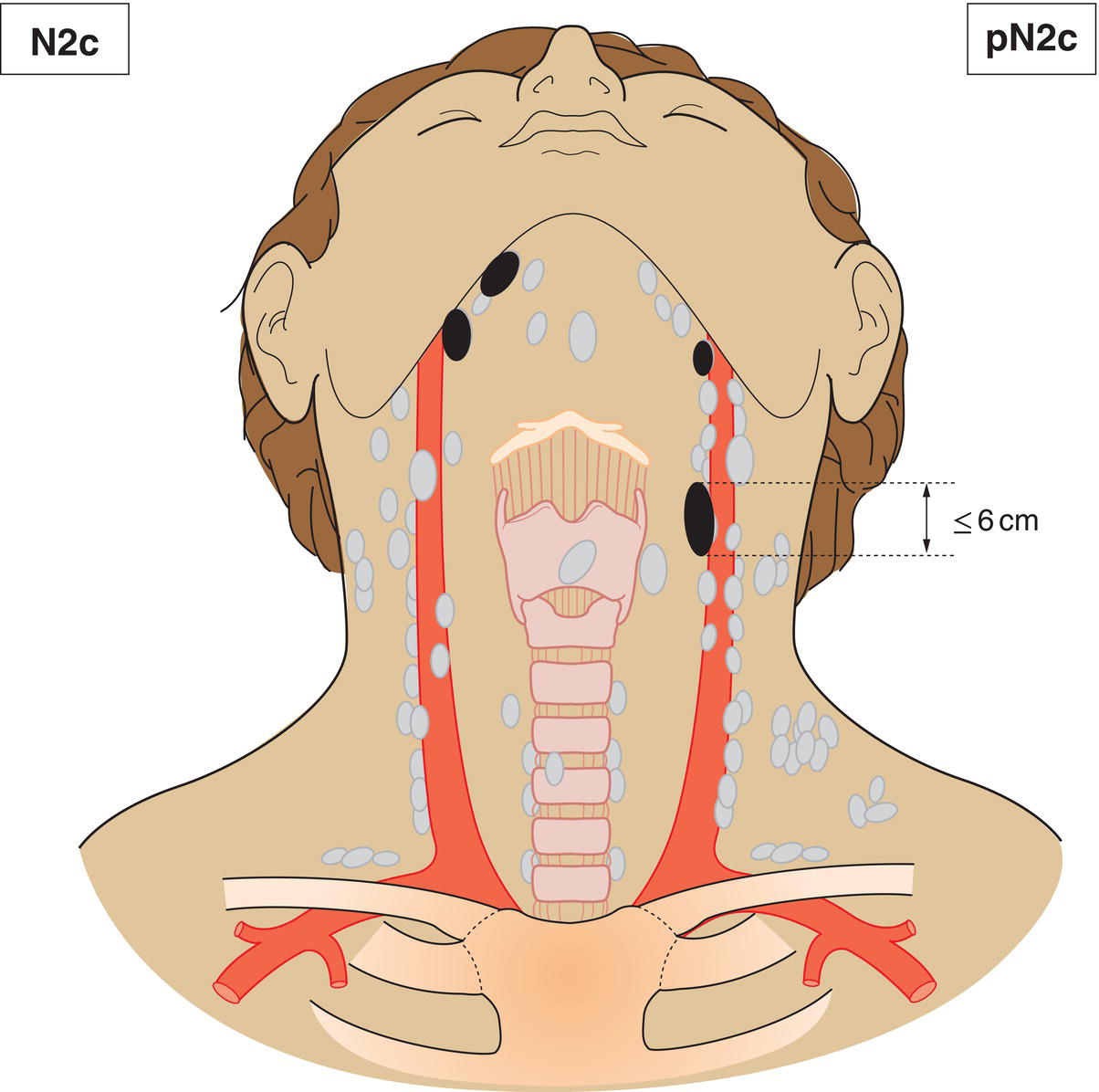 Schematic illustration of Metastasis in bilateral or contralateral lymph nodes, none more than 6 cm in greatest dimension, without extranodal extension.