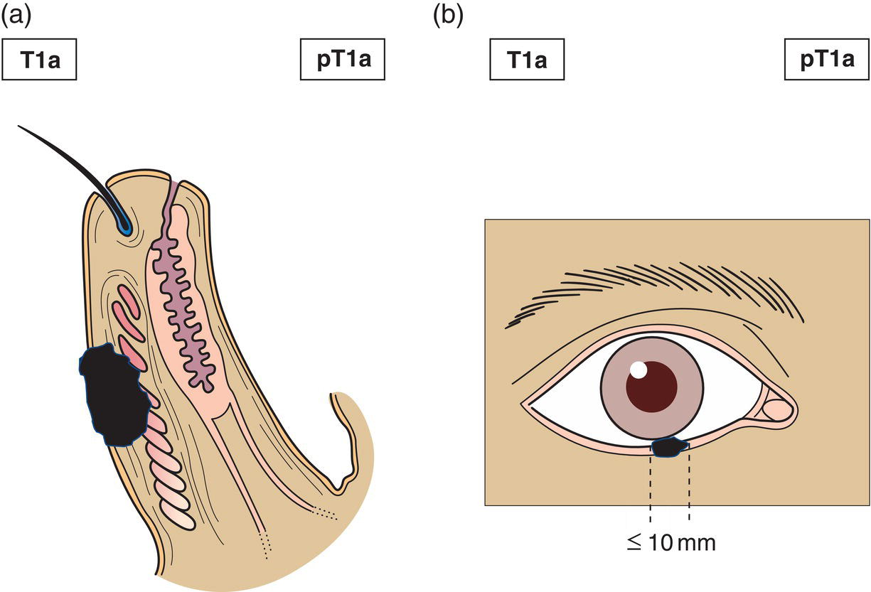 Schematic illustration of tumour 10 mm or less in greatest dimension not invading the tarsal plate or eyelid margin.