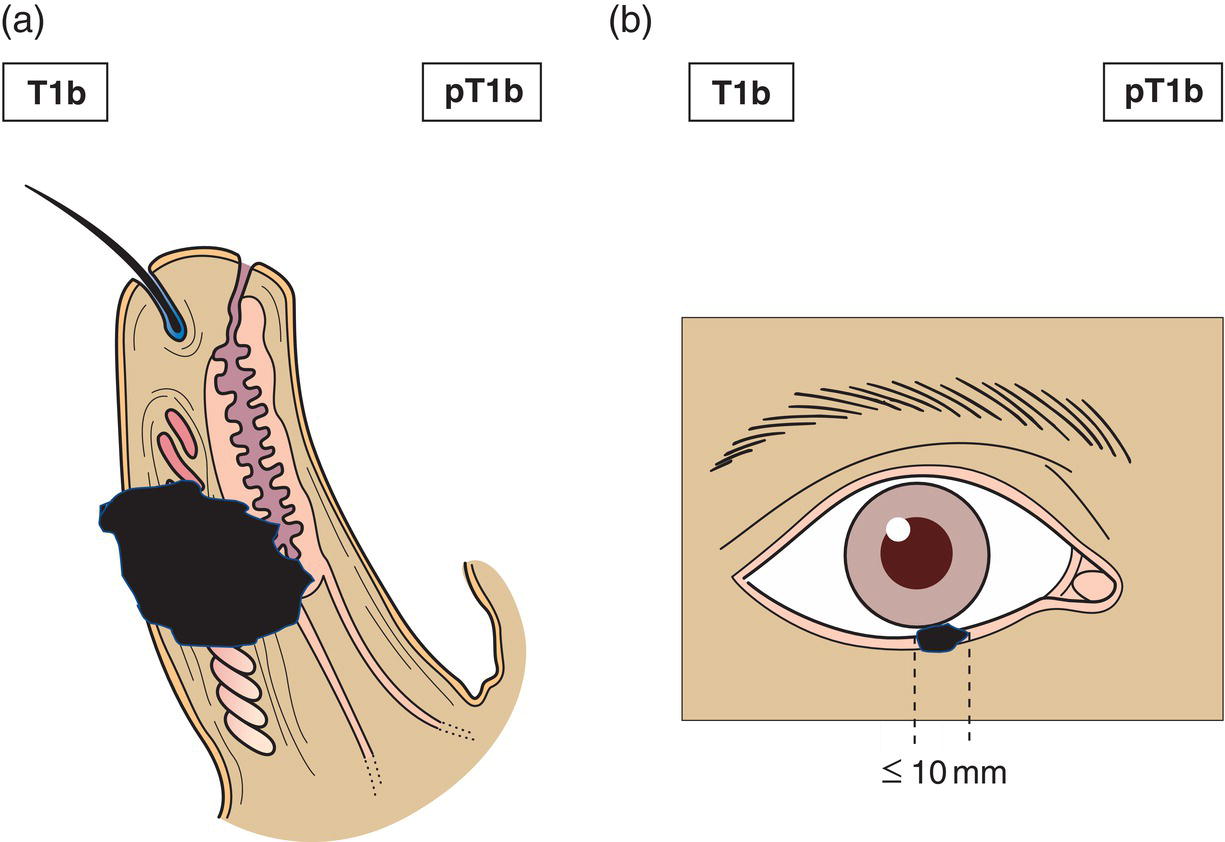 Schematic illustration of tumour 10 mm or less in greatest dimension invades tarsal plate or eyelid margin.