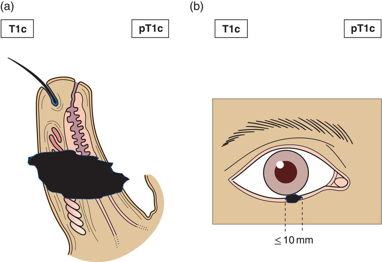 Schematic illustration of tumour 10 mm or less in greatest dimension involves full thickness of eyelid.