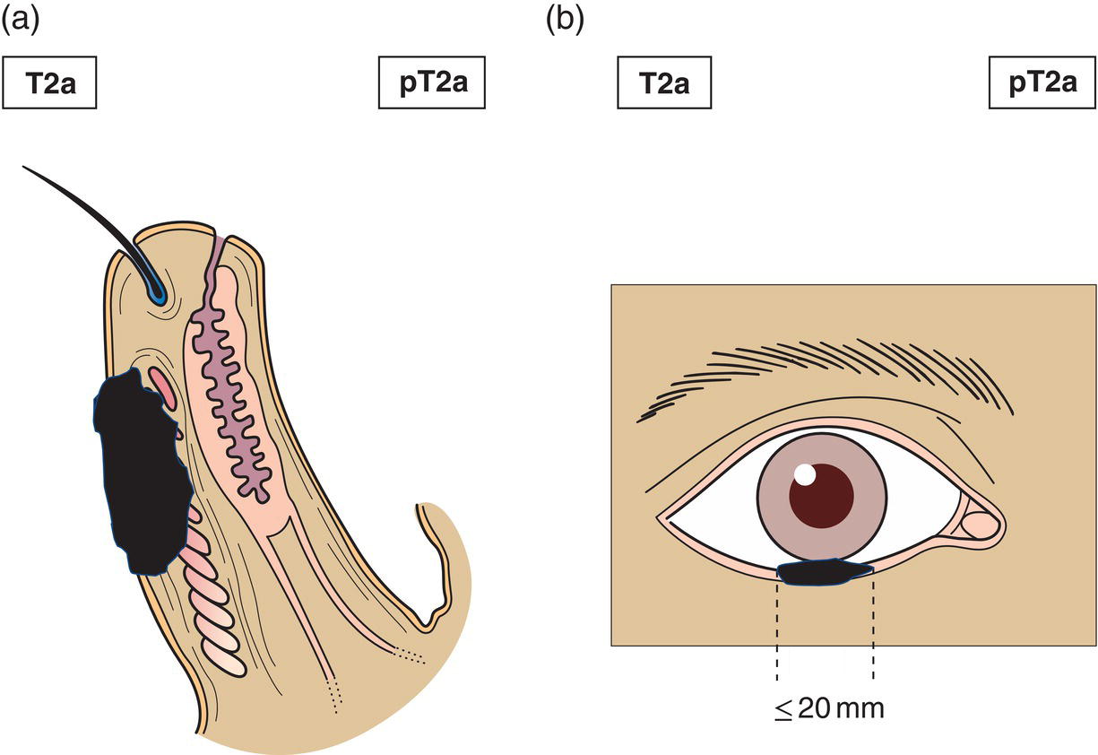 Schematic illustration of tumour greater than or equal to 10 mm, but 20 mm or less in greatest dimension not invading the tarsal plate or eyelid margin.