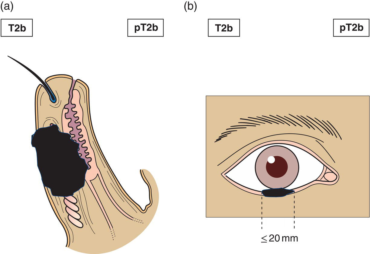 Schematic illustration of tumour greater than or equal to 10 mm, but 20 mm or less in greatest dimension invades the tarsal plate or eyelid margin.