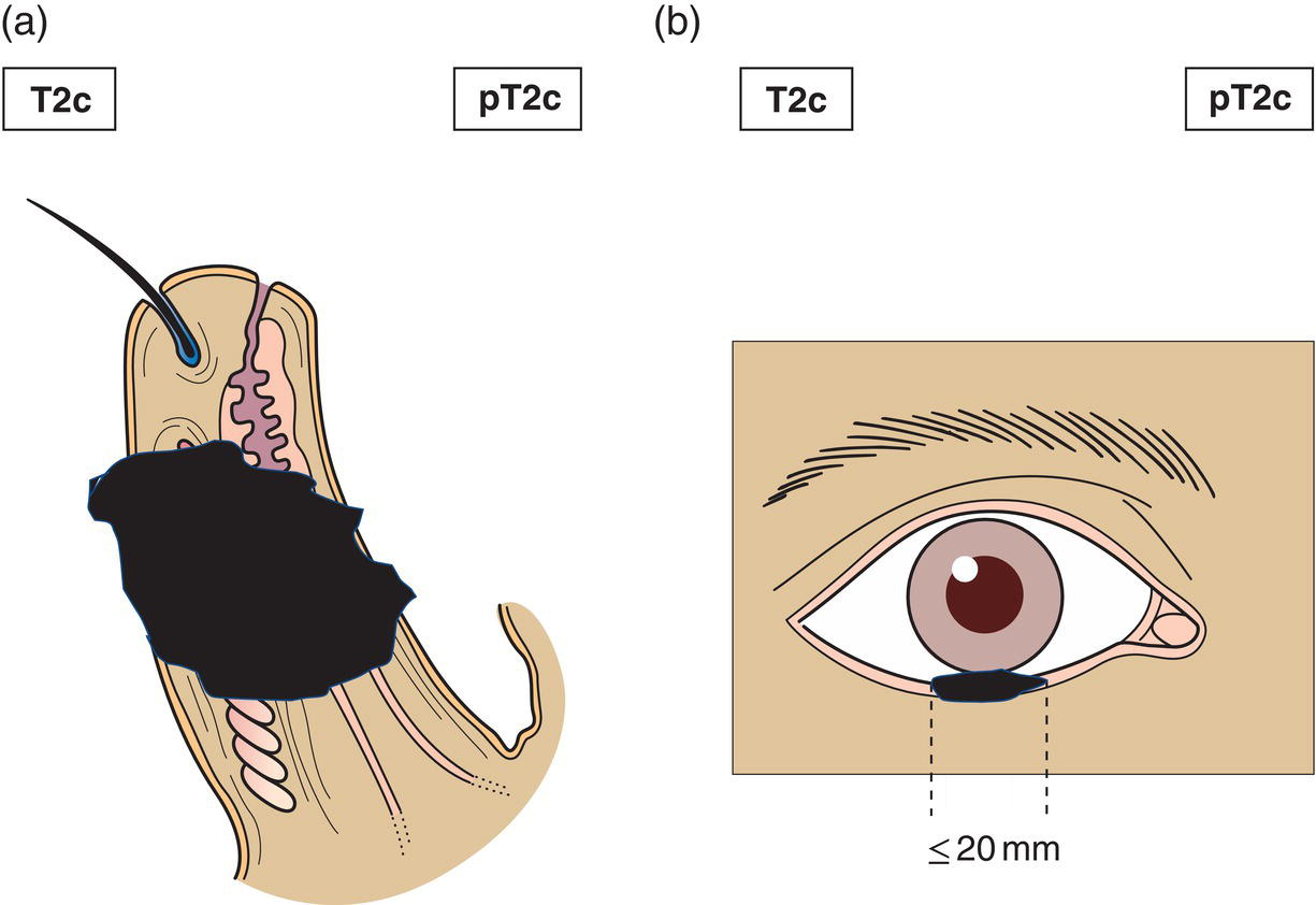 Schematic illustration of tumour greater than or equal to 10 mm, but 20 mm or less in greatest dimension involves full thickness of eyelid.