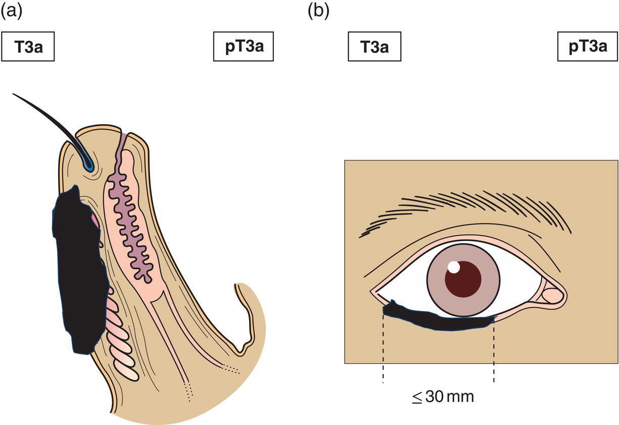 Schematic illustration of tumour greater than or equal to 20 mm, but more than 30 mm in greatest dimension not invading the tarsal plate or eyelid margin.