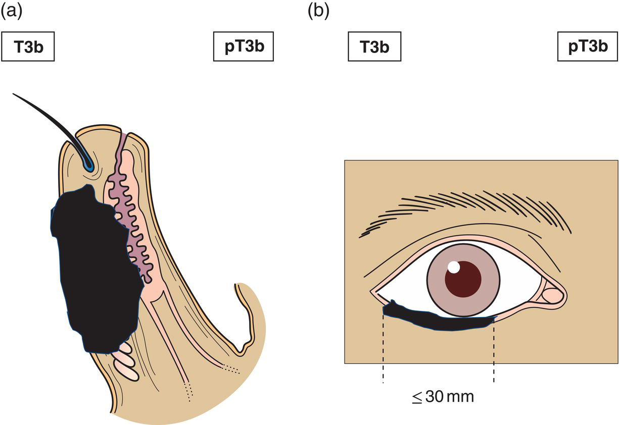 Schematic illustration of tumour greater than or equal to 20 mm, but more than 30 mm in greatest dimension invades tarsal plate or eyelid margin.