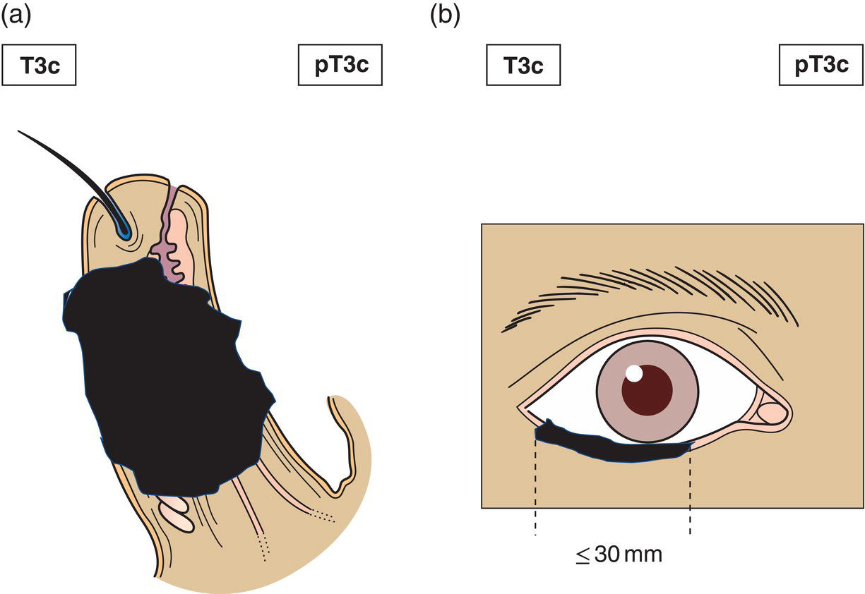 Schematic illustration of tumour greater than or equal to 20 mm, but more than 30 mm in greatest dimension involves full thickness of eyelid.