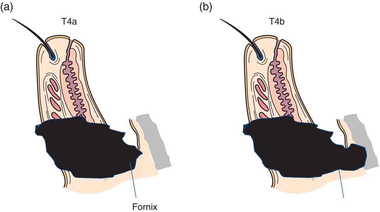 Schematic illustration of Any eyelid tumour that invades adjacent ocular, orbital or facial structures, tumour invades ocular or intraorbital structures, Tumour invades the bony walls of the orbit or extends to paranasal sinuses or invades the lacrimal sac or nasolacrimal duct or brain.