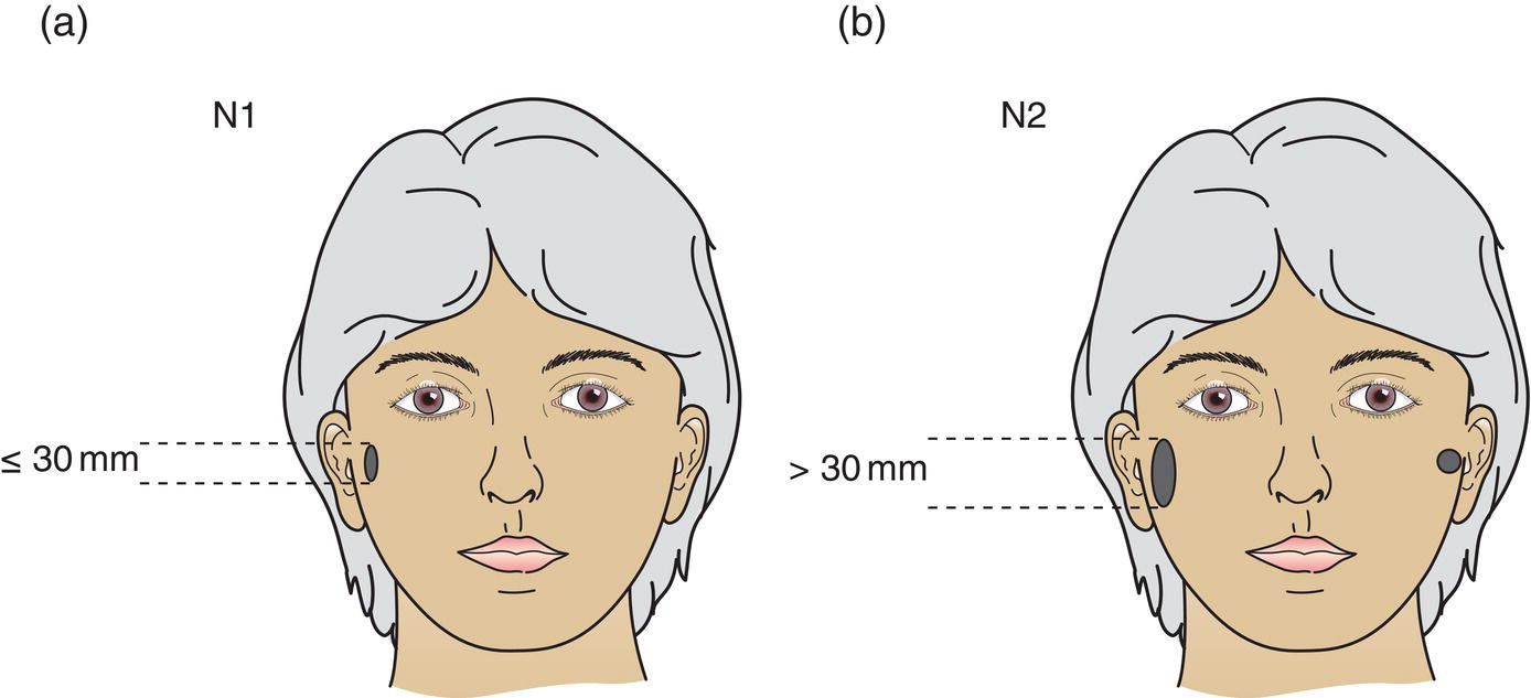 Schematic illustration of Metastasis in a single ipsilateral regional lymph node, 3 cm or less in greatest dimension, Metastasis in a single ipsilateral lymph node more than 3 cm in greatest dimension.