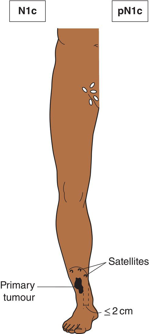 Schematic illustration of Satellite or in-transit metastasis without regional nodal metastasis.