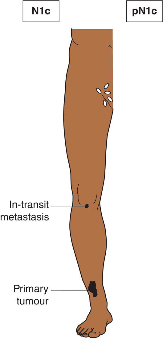 Schematic illustration of Satellite or in-transit metastasis without regional nodal metastasis.