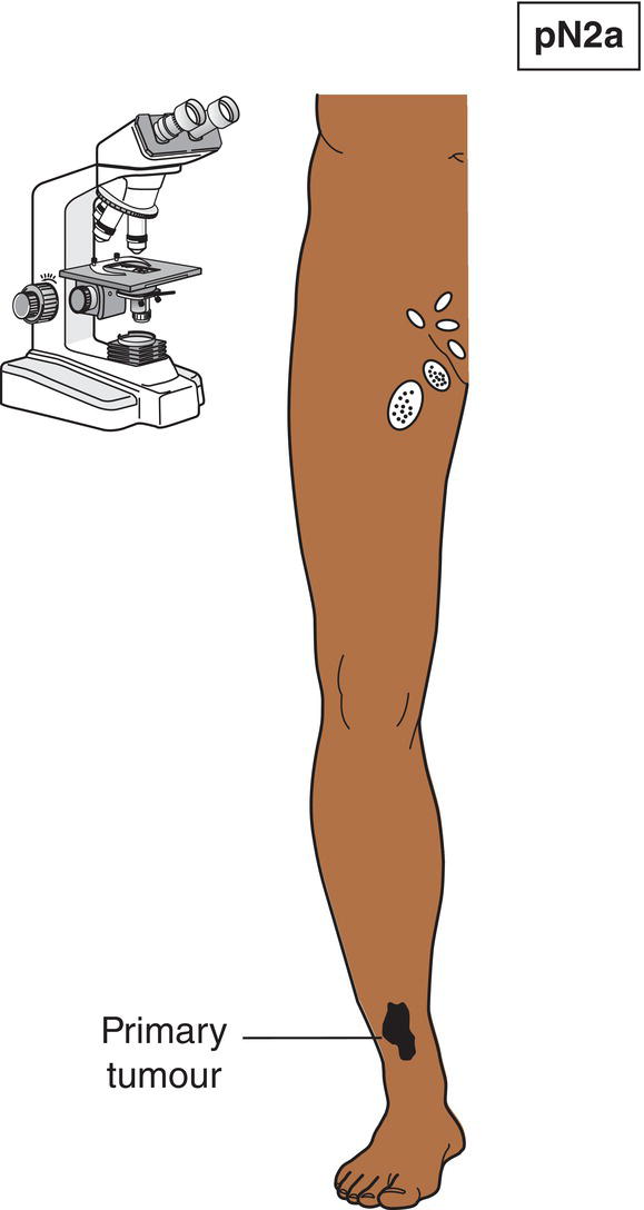 Schematic illustration of Only microscopic nodal metastasis.