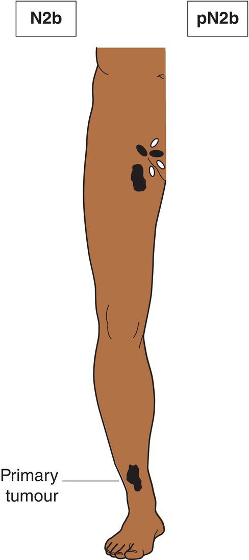 Schematic illustration of Macroscopic nodal metastasis.