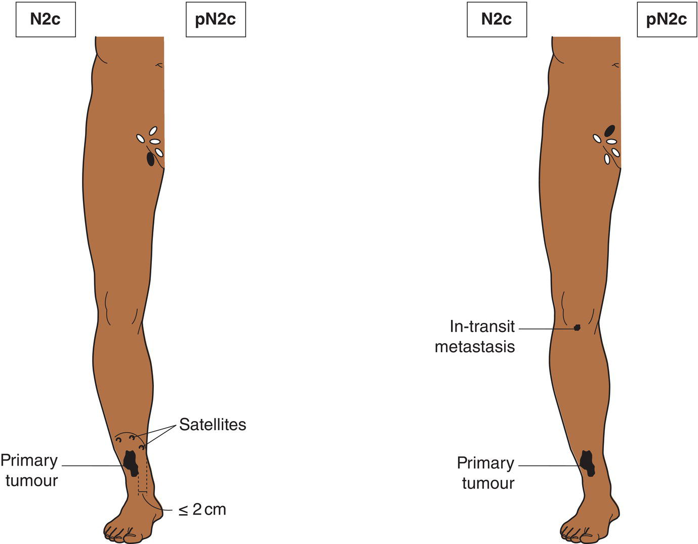 Schematic illustration of Satellite or in-transit metastasis with only one regional nodal metastasis.