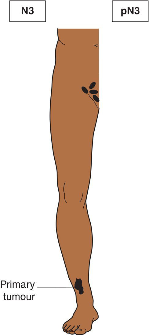 Schematic illustration of Metastasis in four or more regional lymph nodes.