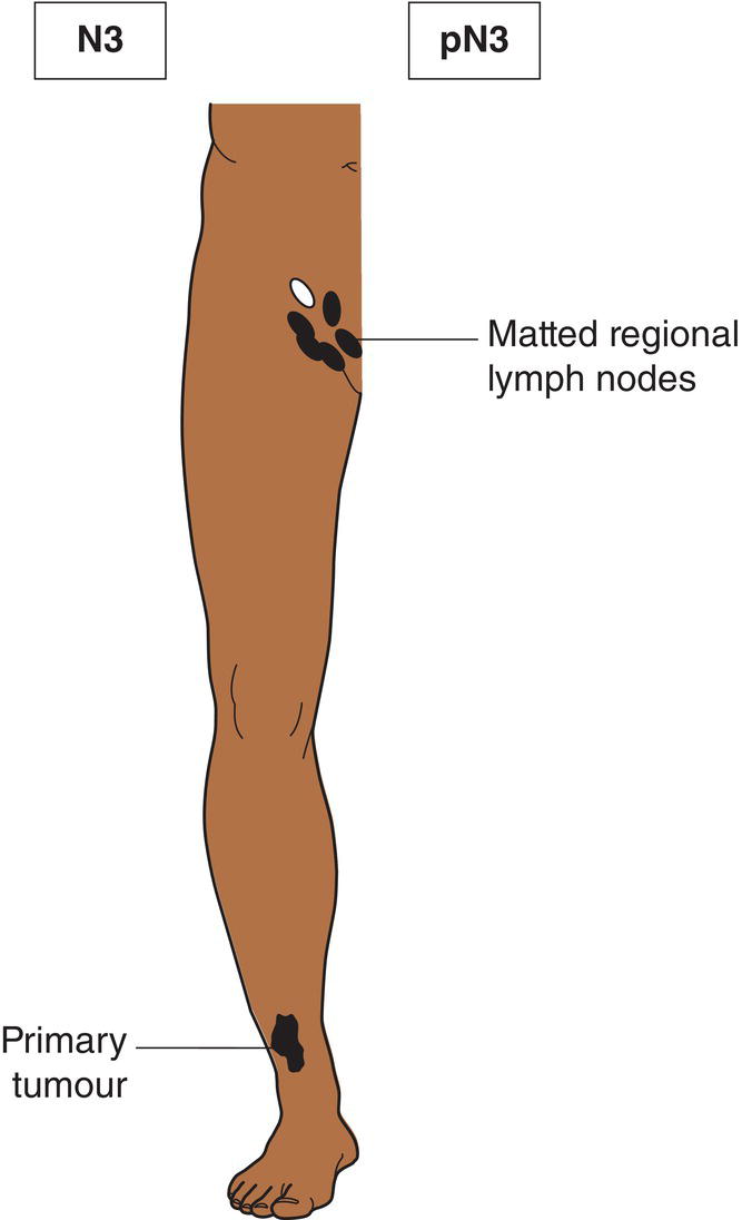 Schematic illustration of matted metastatic regional lymph nodes.