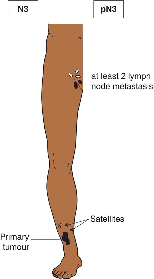 Schematic illustration of satellite(s) or in-transit metastasis with metastasis in regional lymph node.