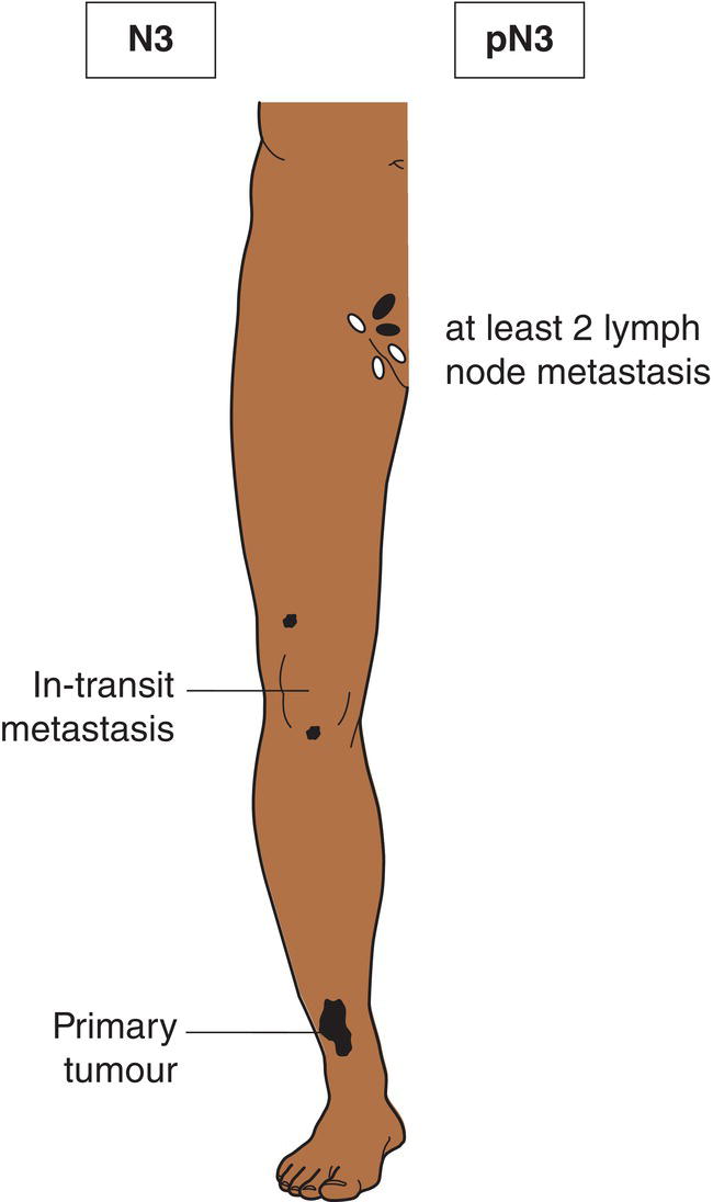 Schematic illustration of satellite(s) or in-transit metastasis with metastasis in regional lymph node(s).