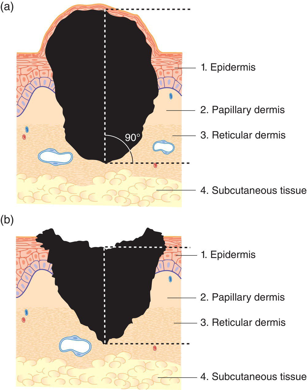 Schematic illustration of tumour thickness (Breslow) according to the largest vertical diameter of the tumour in millimetre.