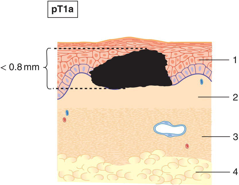 Schematic illustration of Less than 0.8 mm thickness without ulceration.