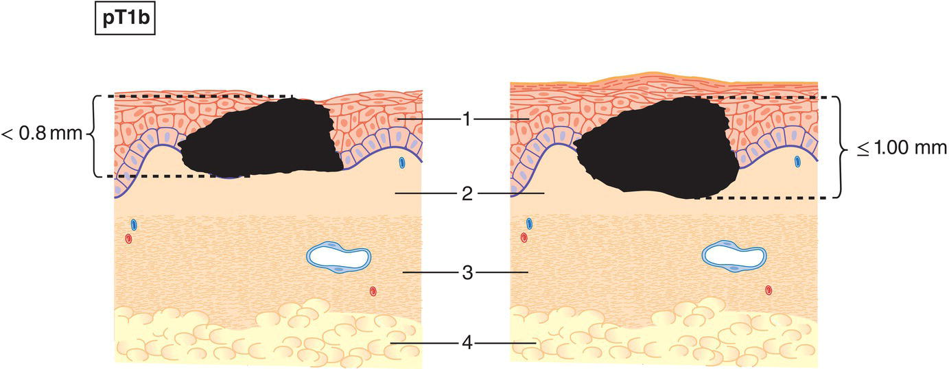 Schematic illustration of Less than 0.8 mm in thickness with ulceration or 0.8 mm or more but no more than 1 mm in thickness, with or without ulceration.