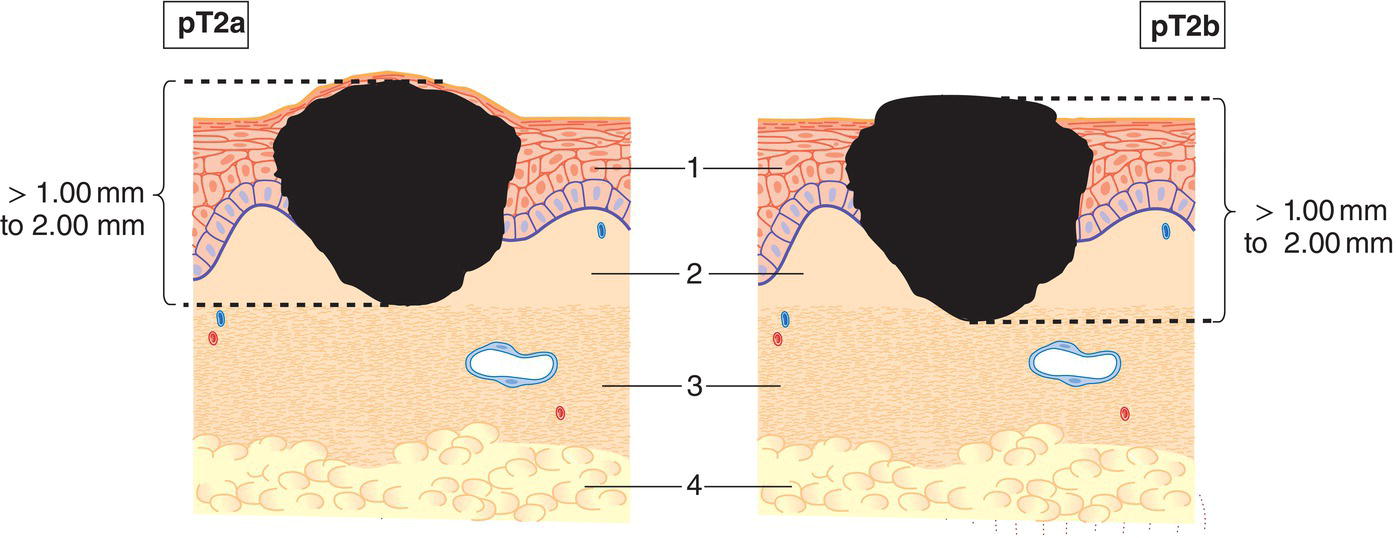 Schematic illustration of tumour more than 1 mm but not more than 2 mm in thickness.