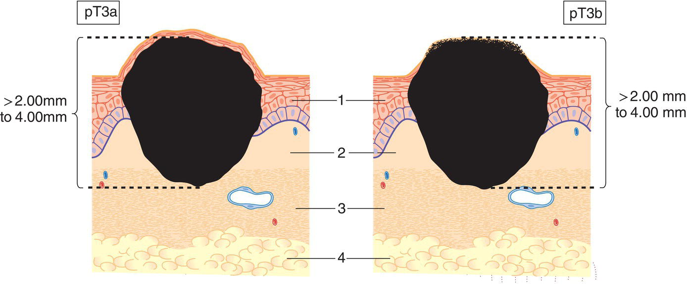 Schematic illustration of tumour more than 2 mm but not more than 4 mm in thickness.