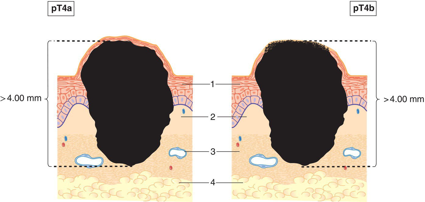 Schematic illustration of tumour more than 4 mm in thickness.