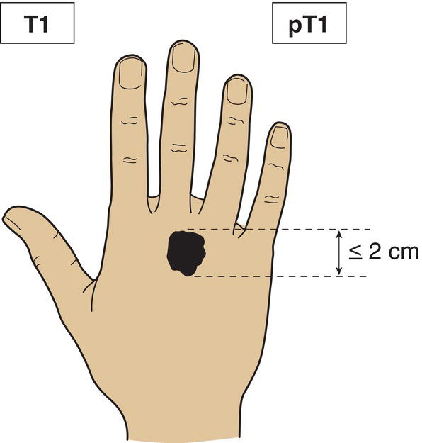 Schematic illustration of tumour 2 cm or less in greatest dimension.