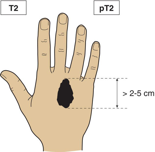 Schematic illustration of tumour more than 2 cm but not more than 5 cm in greatest dimension.