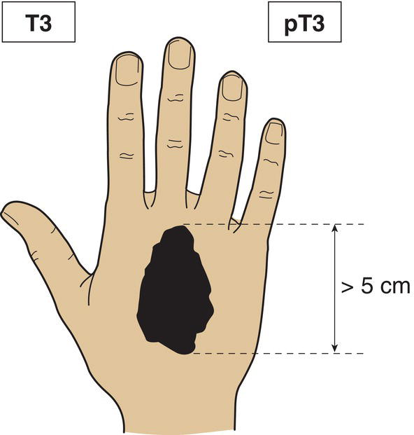 Schematic illustration of tumour more than 5 cm in greatest dimension.