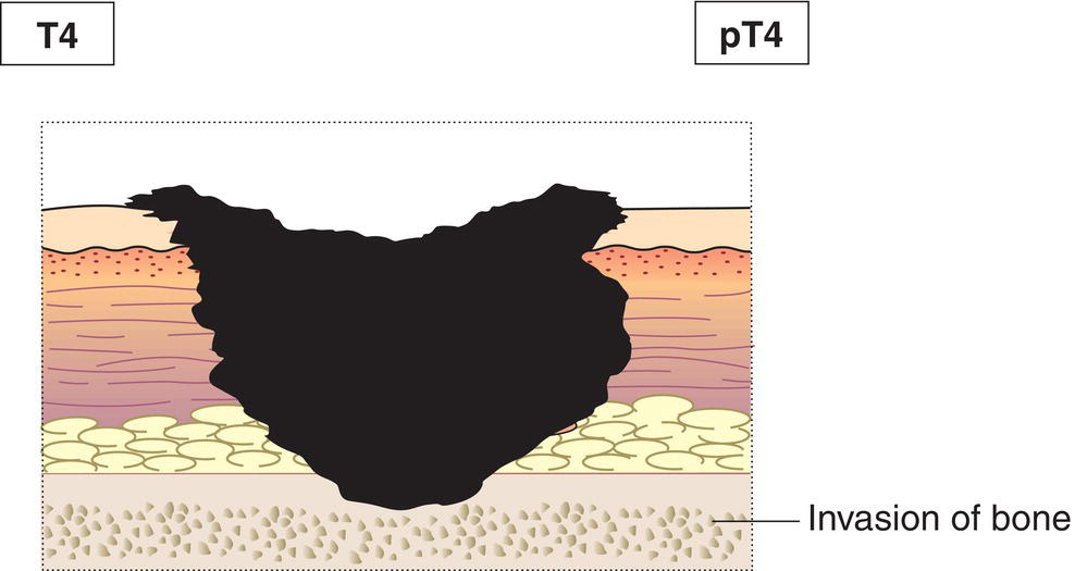 Schematic illustration of tumour invades deep extradermal structures, i.e., cartilage, skeletal muscle, fascia
or bone.