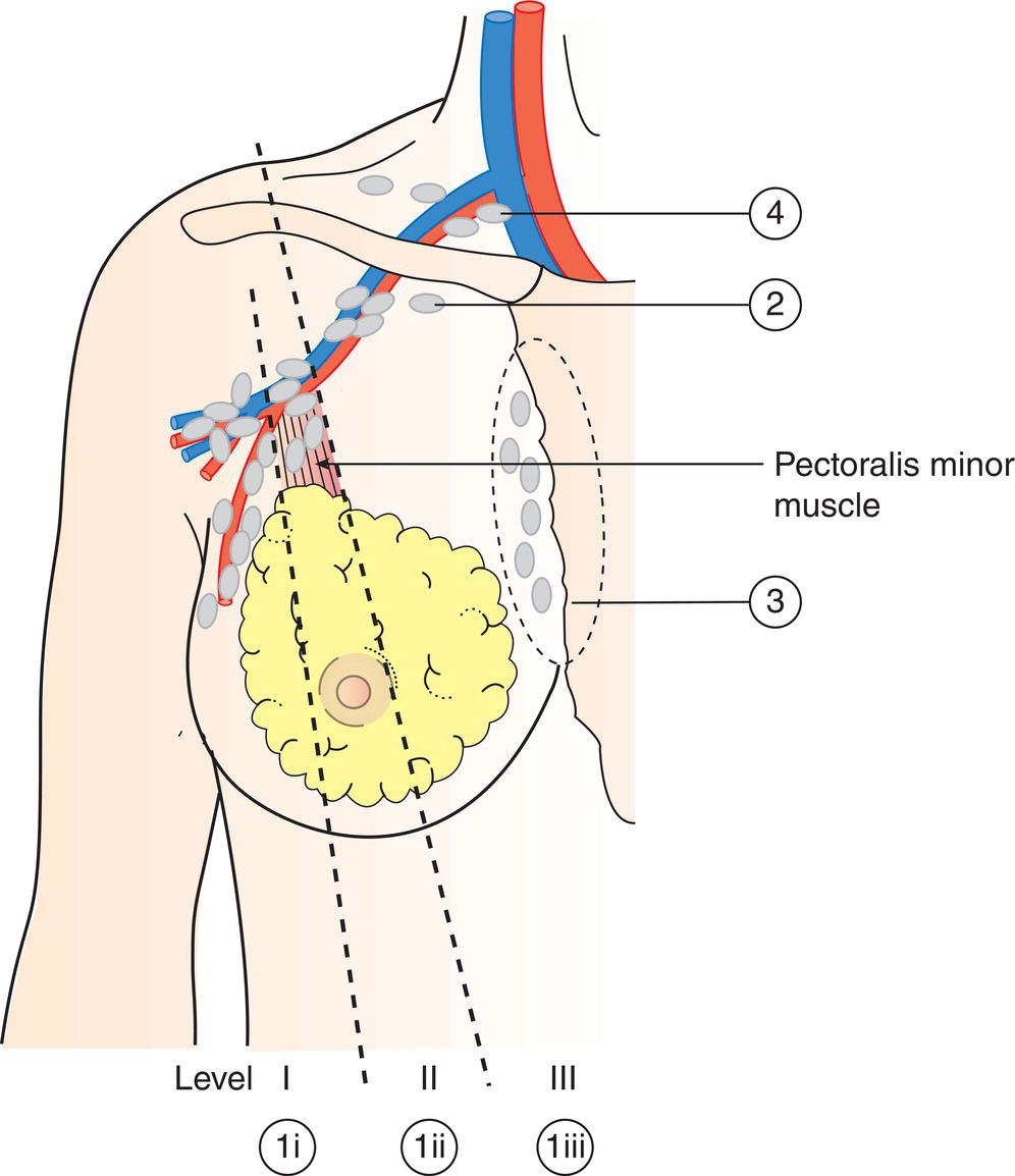 Schematic illustration of Axillary (ipsilateral): interpectoral (Rotter) nodes and lymph nodes along the axillary
vein and its tributaries.