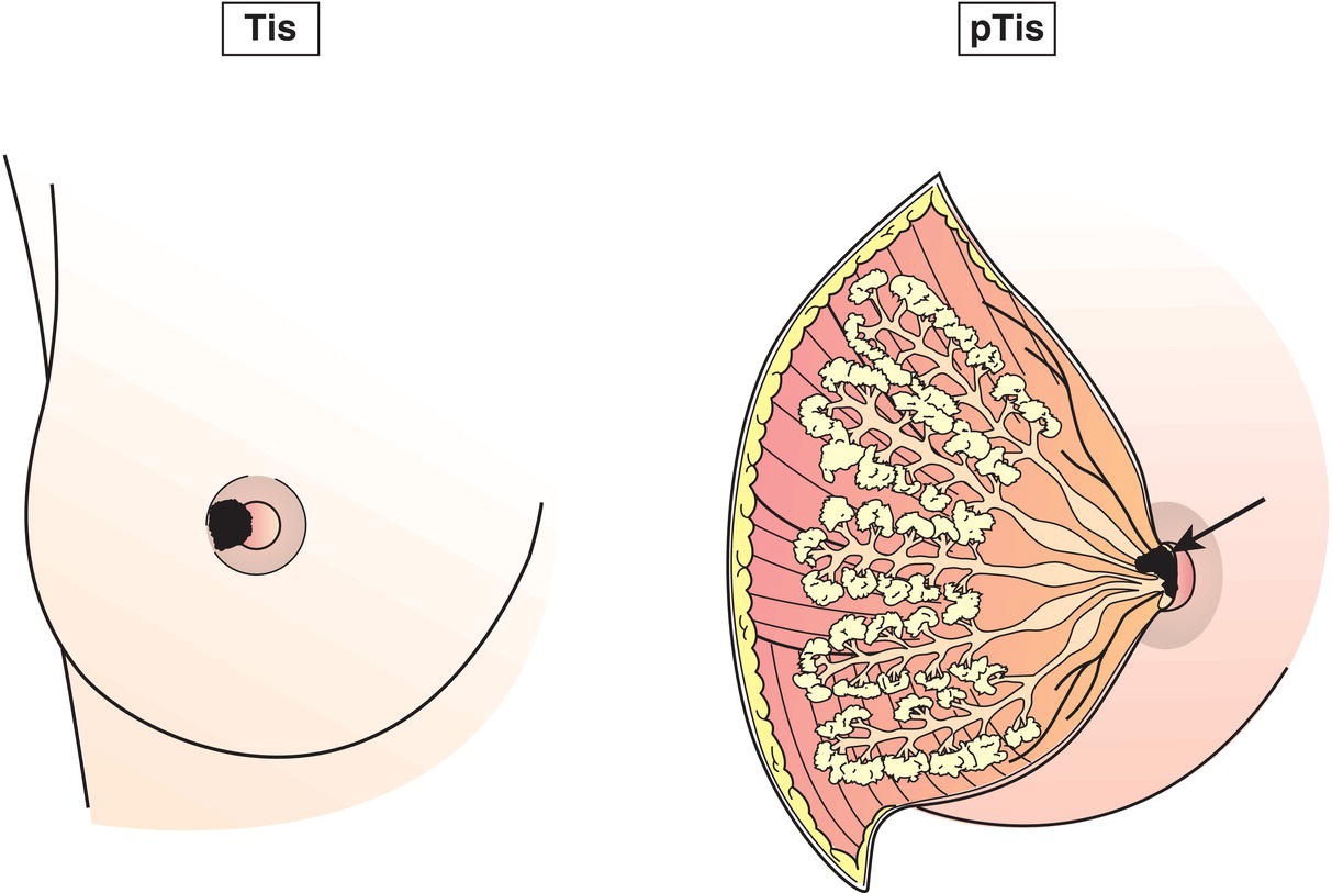 Schematic illustration of Paget disease of the nipple without detectable tumour.