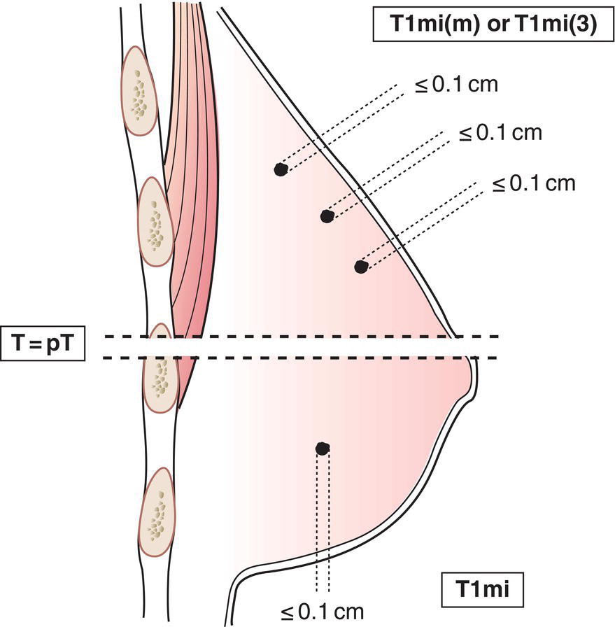 Schematic illustration of Microinvasion 0.1cm or less in greatest dimension.