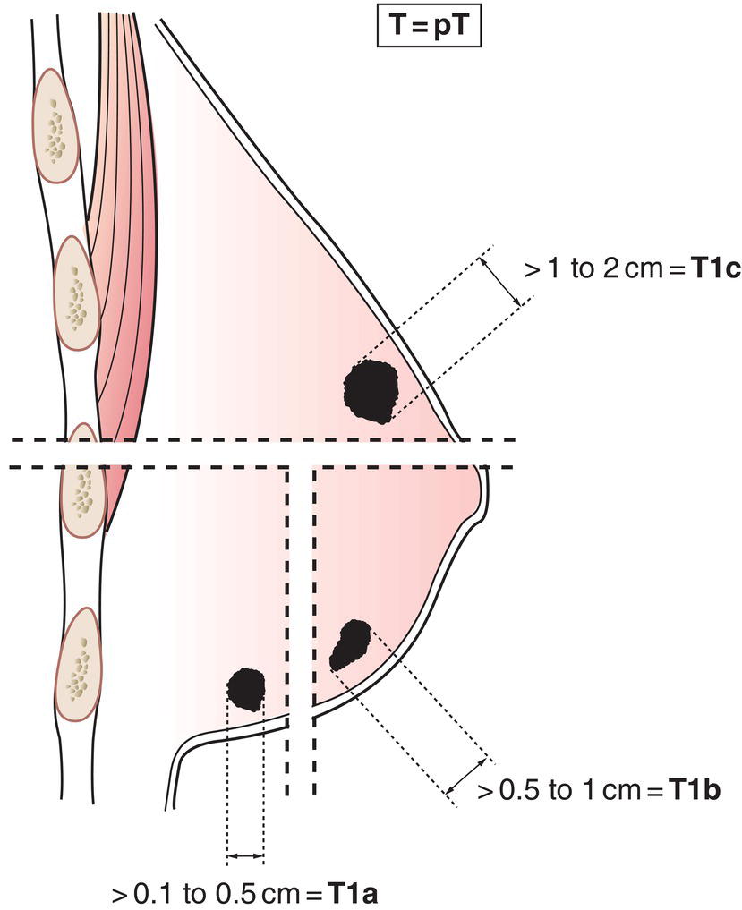 Schematic illustration of More than 0.1cm but not more than 0.5cm in greatest dimension.