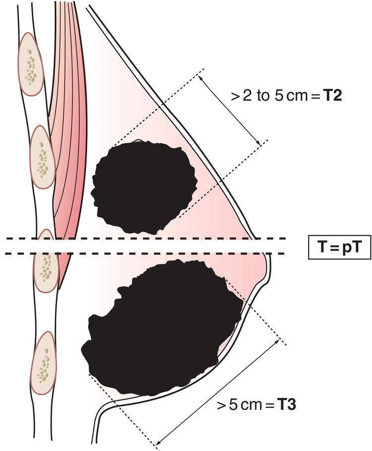 Schematic illustration of tumour more than 2cm but not more than 5cm in greatest dimension.