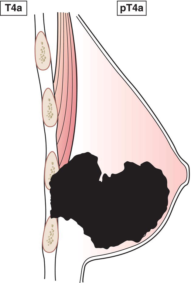 Schematic illustration of Extension to chest wall, not including only pectoralis muscle adherence or invasion.