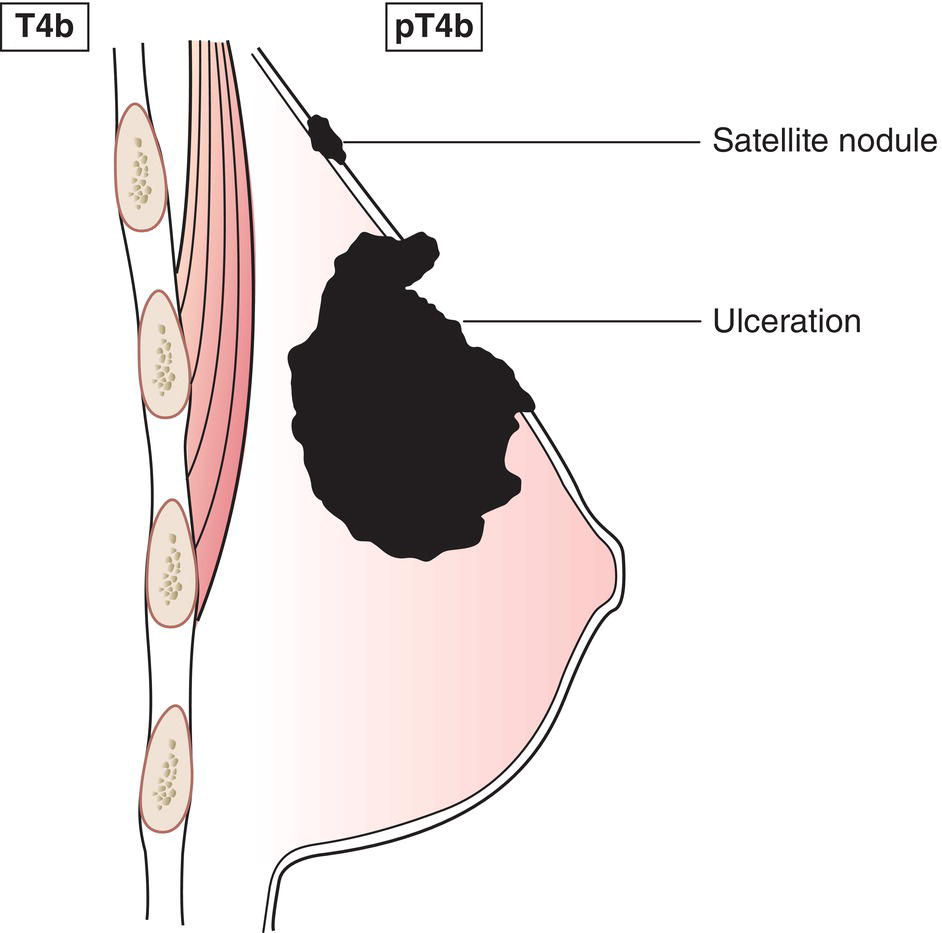 Schematic illustration of Ulceration and ipsilateral satellite skin nodules and oedema of the skin which do not meet the criteria for inflammatory carcinoma.