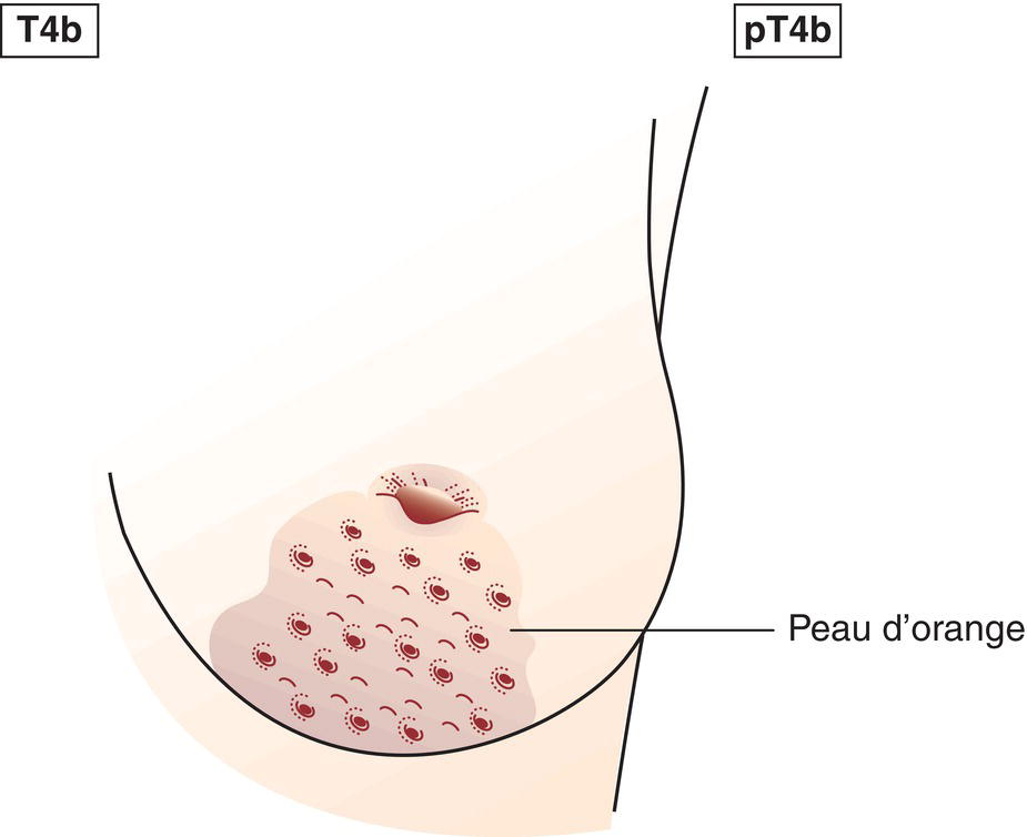 Schematic illustration of Ulceration and ipsilateral satellite skin nodules and oedema of the skin which do not meet the criteria for inflammatory carcinoma.