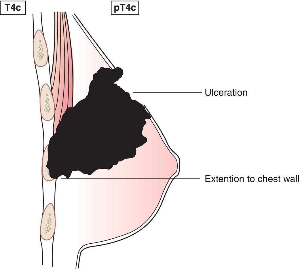 Schematic illustration of Ulceration and ipsilateral satellite skin nodules and oedema of the skin which do not meet the criteria for inflammatory carcinoma.