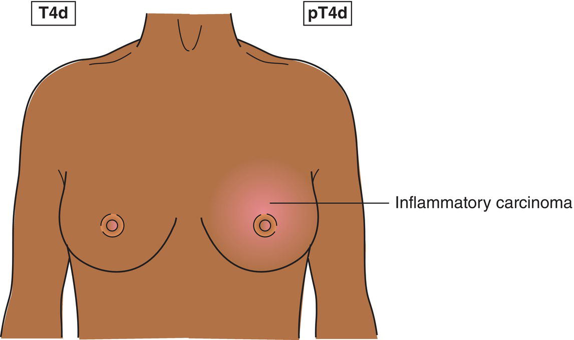 Schematic illustration of Inflammatory carcinoma.