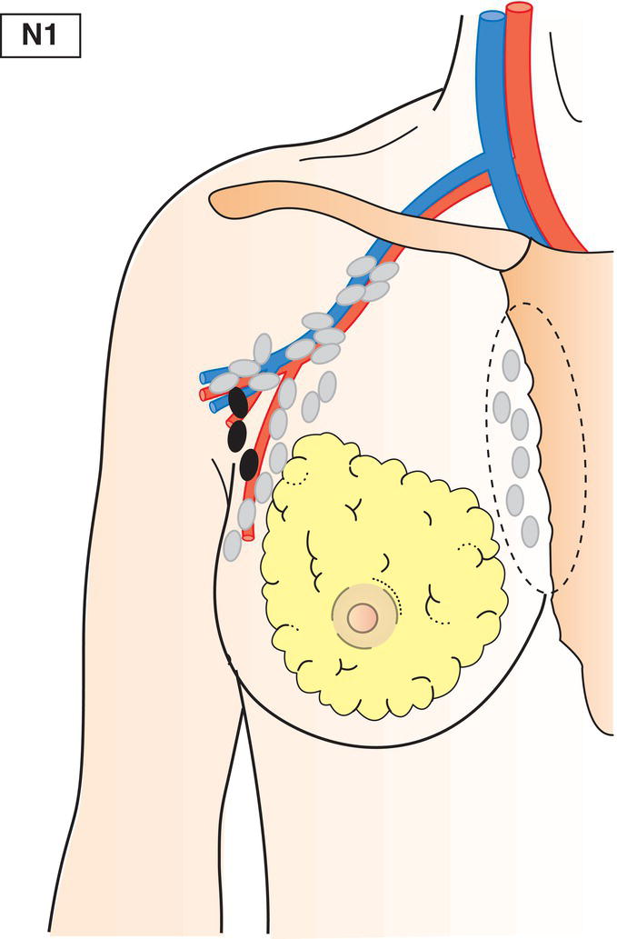 Schematic illustration of Metastasis in movable ipsilateral level I, II axillary lymph node(s).