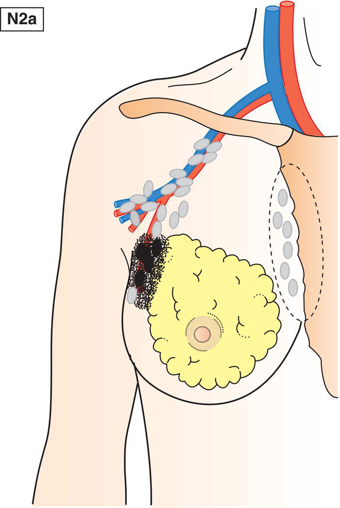 Schematic illustration of Metastasis in axillary lymph node(s) fixed to one another (matted) or to other structures.