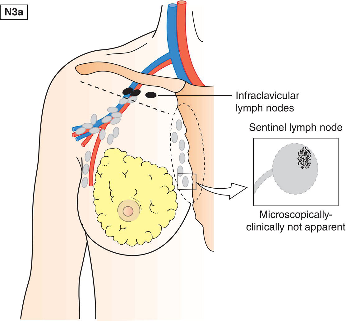 Schematic illustration of Metastasis in infraclavicular lymph node(s).