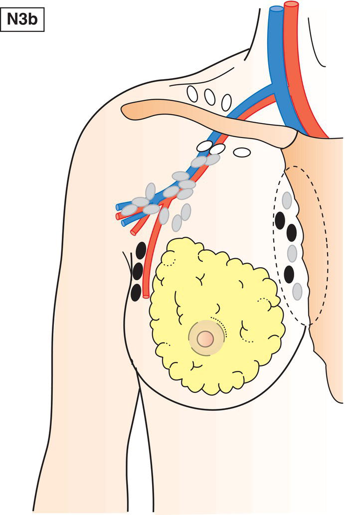 Schematic illustration of Metastasis in internal mammary and axillary lymph nodes.