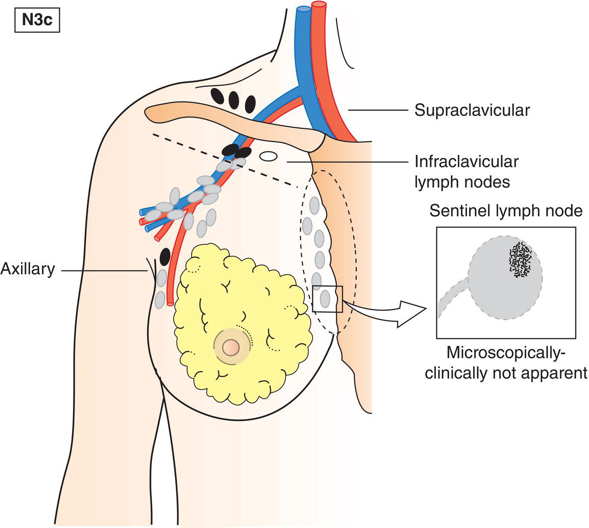 Schematic illustration of Metastasis in supraclavicular lymph node(s).