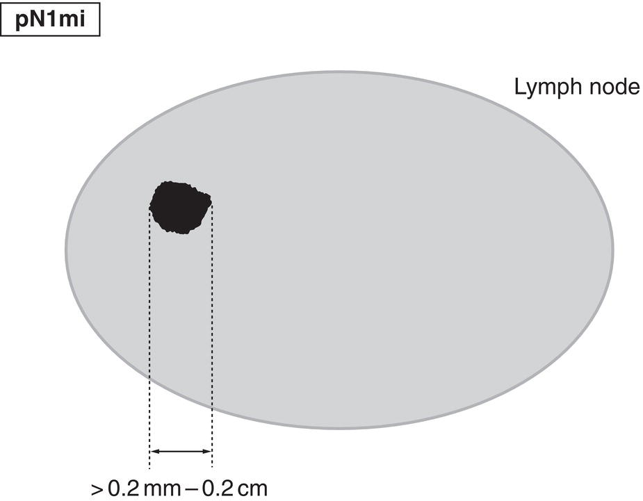 Schematic illustration of Micrometastases.